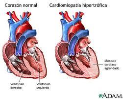 microcardiopatía hipertrófica 