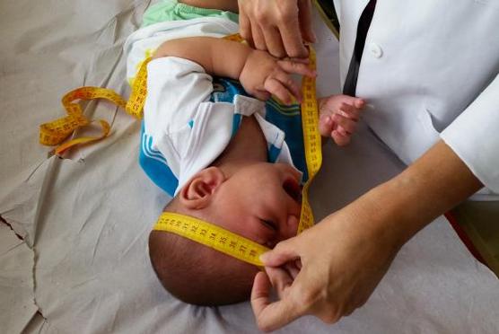 Un medico mide el cráneo de un bebé en Sao Paulo