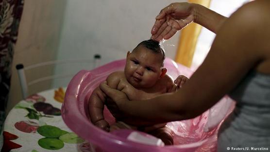 Una madre baña a su bebé con microcefalia
