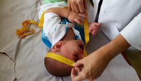 Una enfermera mide el cráneo de niño con micrcefalia